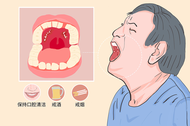 杭州御和堂中医院：如何通过自检发现口腔癌。