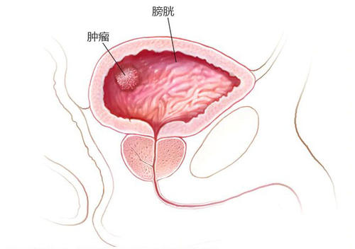膀胱癌是怎么引起的?