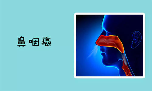鼻咽癌晚期的症状表现，视力障碍要小心!